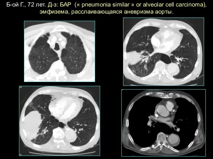 Б-oй Г., 72 лет. Д-з: БАР (« pneumonia similar » or