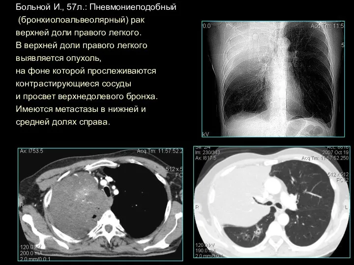 Больной И., 57л.: Пневмониеподобный (бронхиолоальвеолярный) рак верхней доли правого легкого. В