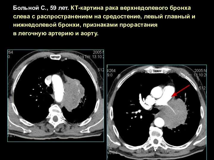 Больной С., 59 лет. КТ-картина рака верхнедолевого бронха слева с распространением