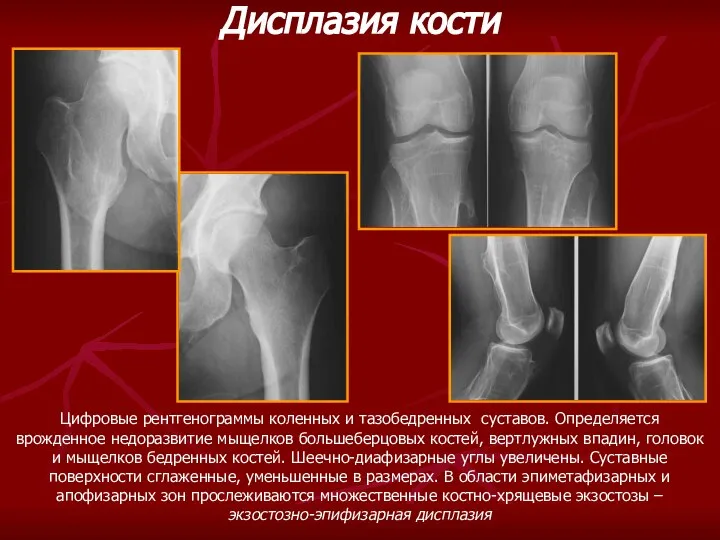 Цифровые рентгенограммы коленных и тазобедренных суставов. Определяется врожденное недоразвитие мыщелков большеберцовых