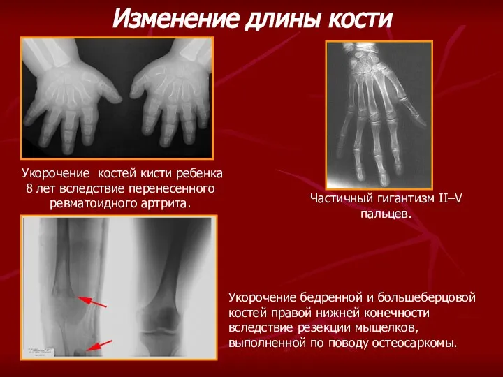 Частичный гигантизм II–V пальцев. Укорочение костей кисти ребенка 8 лет вследствие