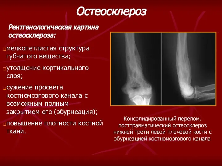 Рентгенологическая картина остеосклероза: мелкопетлистая структура губчатого вещества; утолщение кортикального слоя; сужение
