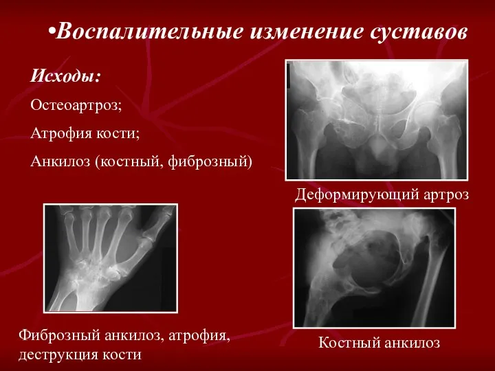 Воспалительные изменение суставов Исходы: Остеоартроз; Атрофия кости; Анкилоз (костный, фиброзный) Деформирующий