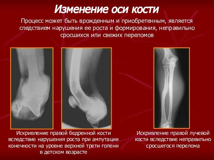 Искривление правой лучевой кости вследствие неправильно сросшегося перелома Изменение оси кости