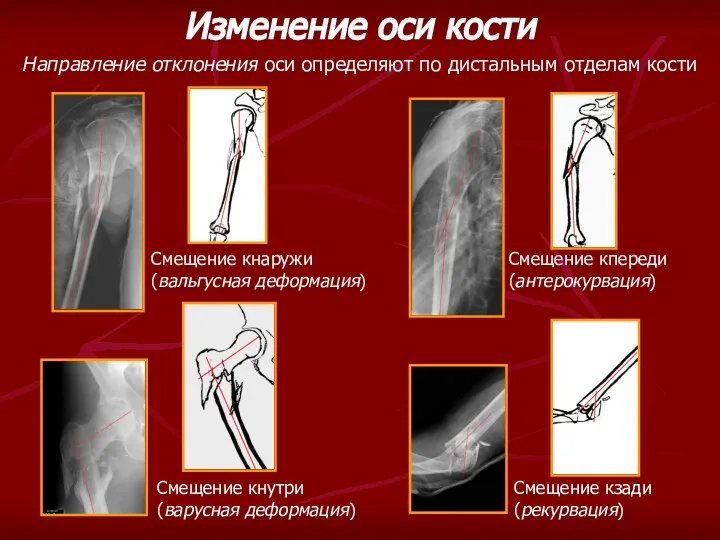 Изменение оси кости Направление отклонения оси определяют по дистальным отделам кости