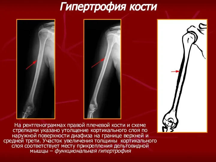 На рентгенограммах правой плечевой кости и схеме стрелками указано утолщение кортикального