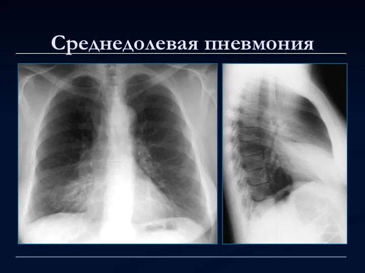 Среднедолевая пневмония