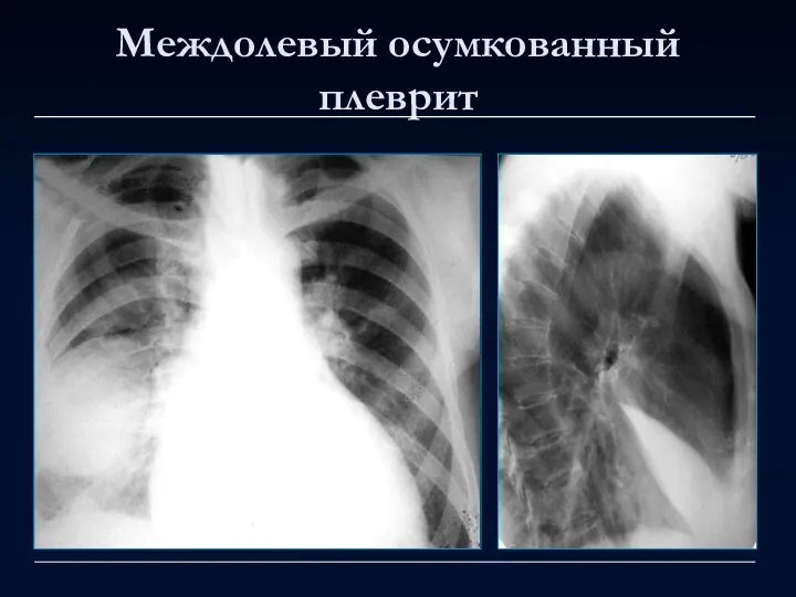 Междолевый осумкованный плеврит