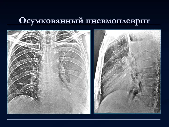 Осумкованный пневмоплеврит