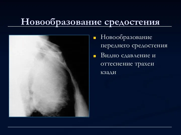 Новообразование средостения Новообразование переднего средостения Видно сдавление и оттеснение трахеи кзади