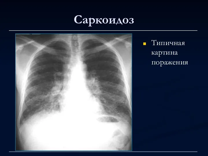 Саркоидоз Типичная картина поражения