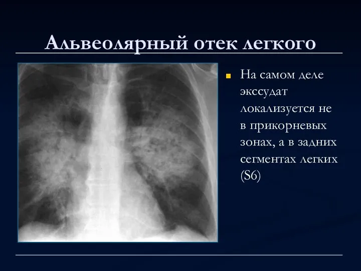 Альвеолярный отек легкого На самом деле экссудат локализуется не в прикорневых