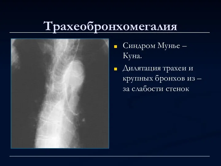 Трахеобронхомегалия Синдром Мунье – Куна. Дилятация трахеи и крупных бронхов из – за слабости стенок