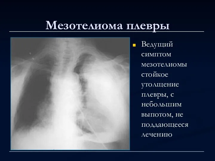 Мезотелиома плевры Ведущий симптом мезотелиомы стойкое утолщение плевры, с небольшим выпотом, не поддающееся лечению