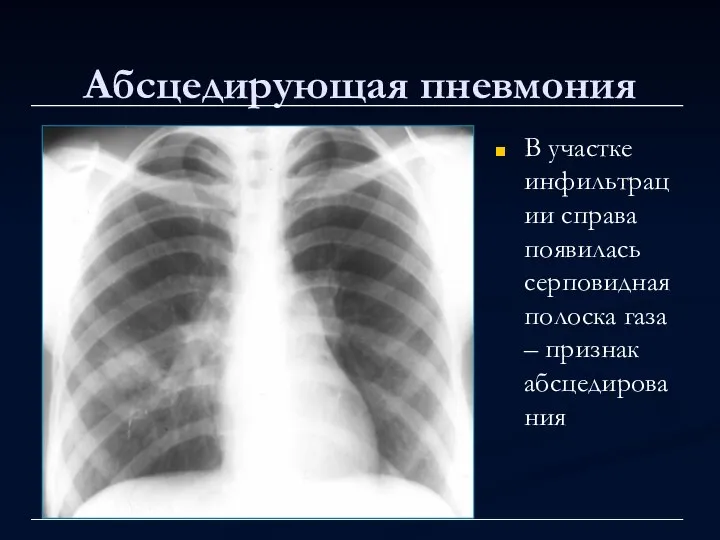 Абсцедирующая пневмония В участке инфильтрации справа появилась серповидная полоска газа – признак абсцедирования