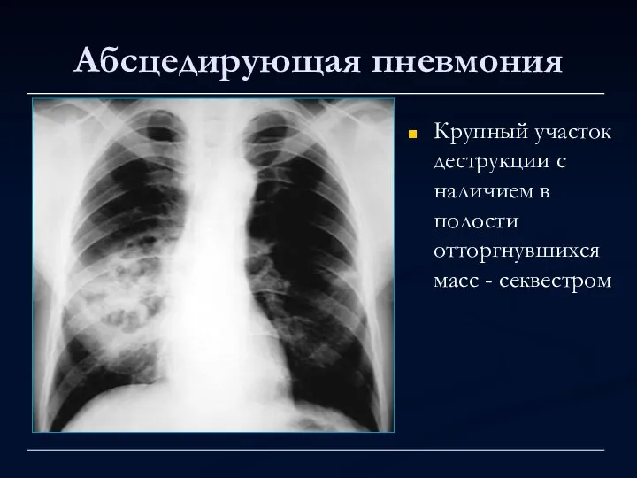 Абсцедирующая пневмония Крупный участок деструкции с наличием в полости отторгнувшихся масс - секвестром