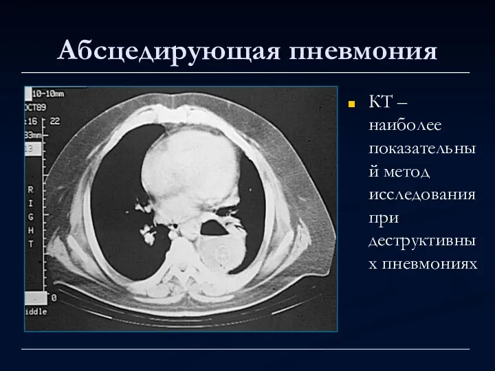 Абсцедирующая пневмония КТ – наиболее показательный метод исследования при деструктивных пневмониях