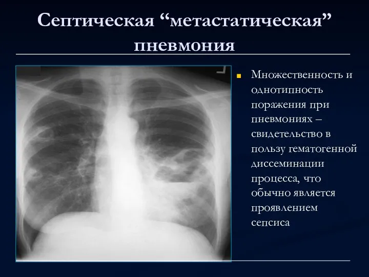 Септическая “метастатическая” пневмония Множественность и однотипность поражения при пневмониях – свидетельство