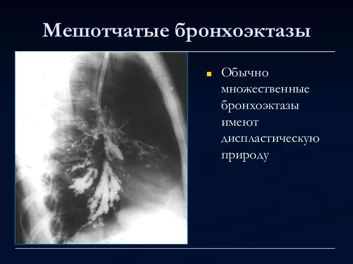 Мешотчатые бронхоэктазы Обычно множественные бронхоэктазы имеют диспластическую природу