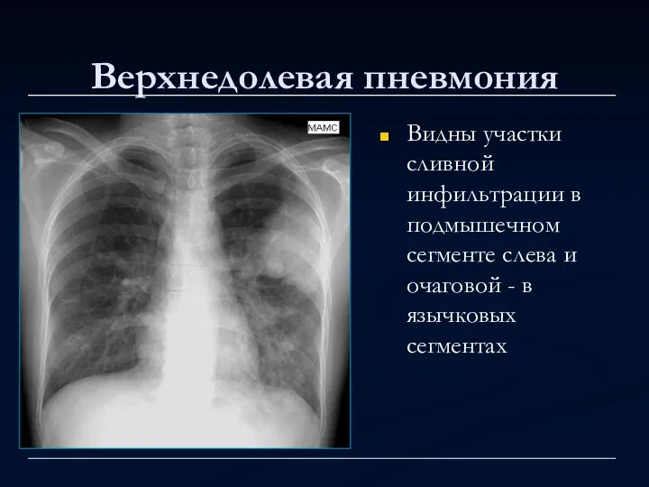 Верхнедолевая пневмония Видны участки сливной инфильтрации в подмышечном сегменте слева и очаговой - в язычковых сегментах