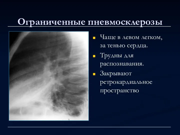 Ограниченные пневмосклерозы Чаще в левом легком, за тенью сердца. Трудны для распознавания. Закрывают ретрокардиальное пространство