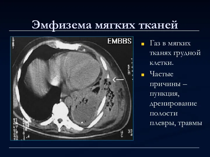 Эмфизема мягких тканей Газ в мягких тканях грудной клетки. Частые причины