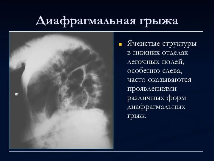 Диафрагмальная грыжа Ячеистые структуры в нижних отделах легочных полей, особенно слева,