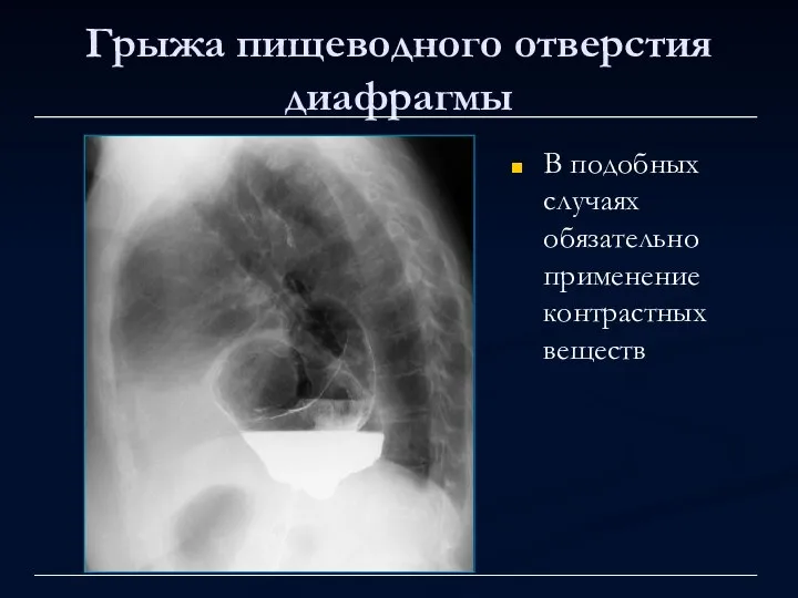 Грыжа пищеводного отверстия диафрагмы В подобных случаях обязательно применение контрастных веществ