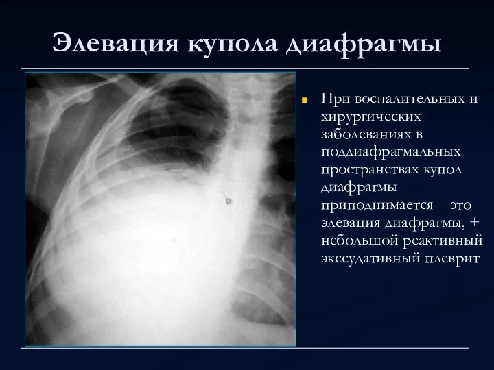 Элевация купола диафрагмы При воспалительных и хирургических заболеваниях в поддиафрагмальных пространствах