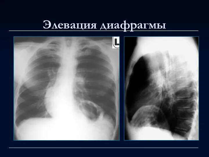 Элевация диафрагмы