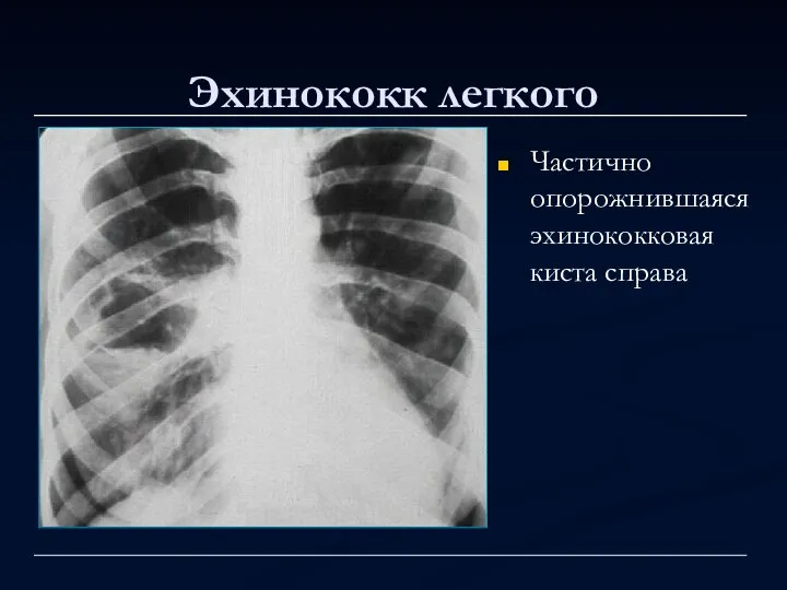 Эхинококк легкого Частично опорожнившаяся эхинококковая киста справа