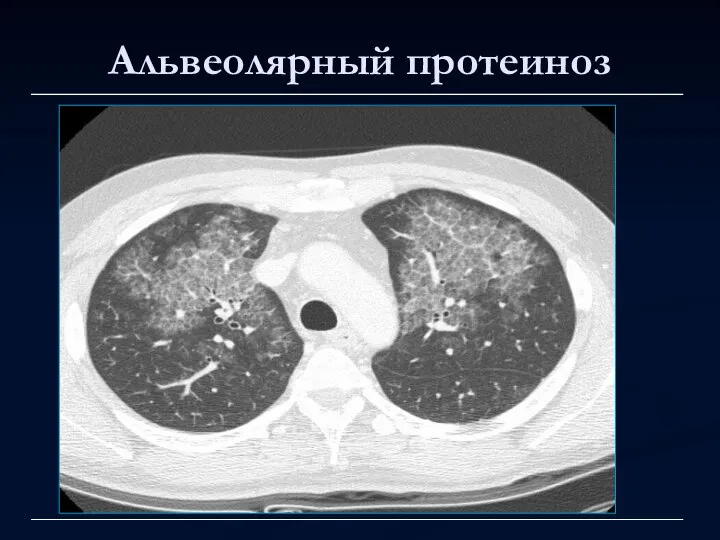 Альвеолярный протеиноз