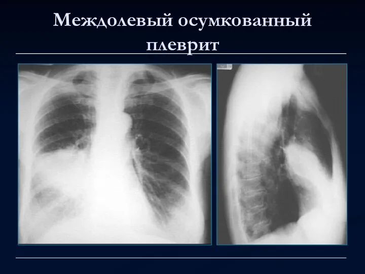 Междолевый осумкованный плеврит