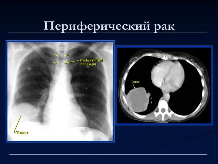 Периферический рак