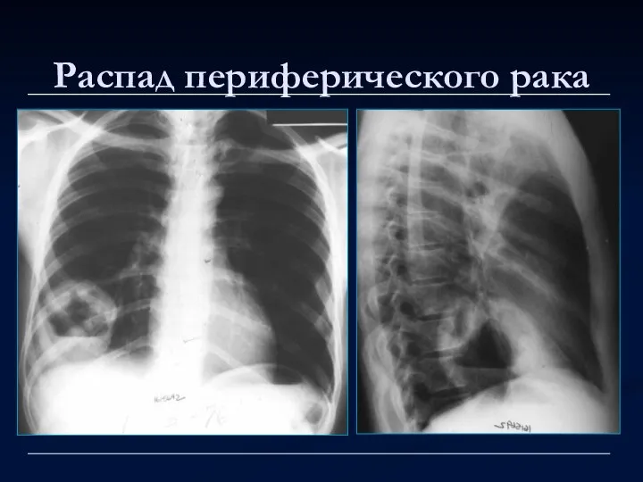 Распад периферического рака