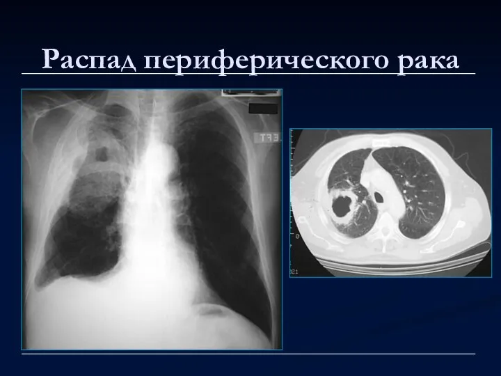 Распад периферического рака