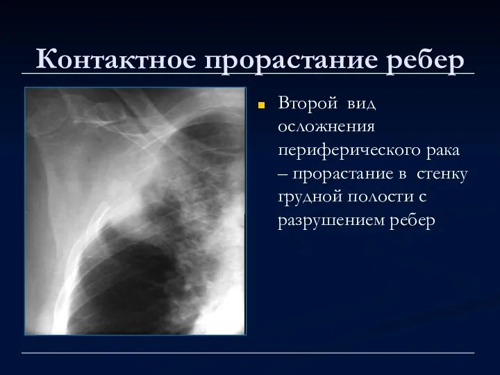 Контактное прорастание ребер Второй вид осложнения периферического рака – прорастание в