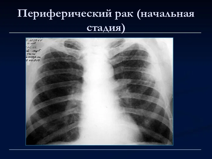 Периферический рак (начальная стадия)