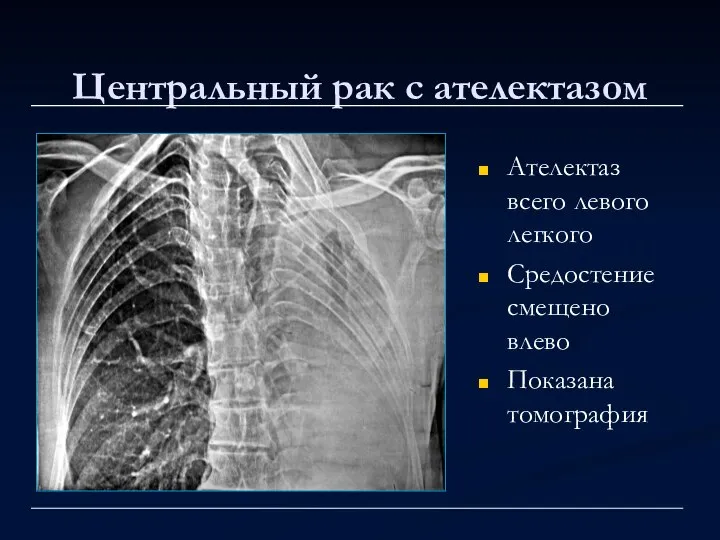 Центральный рак с ателектазом Ателектаз всего левого легкого Средостение смещено влево Показана томография