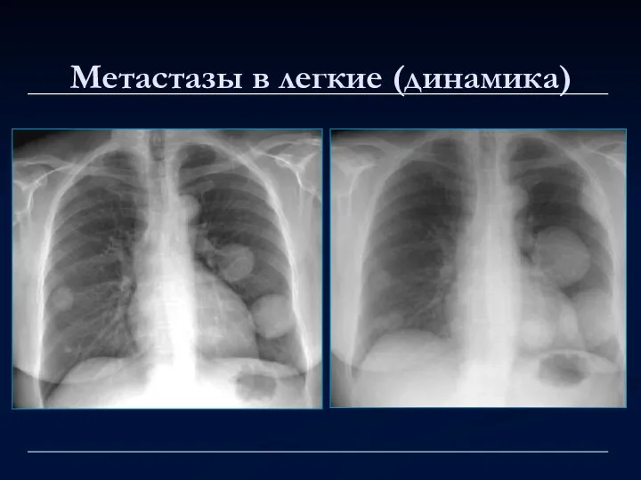 Метастазы в легкие (динамика)