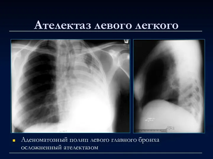 Ателектаз левого легкого Аденоматозный полип левого главного бронха осложненный ателектазом