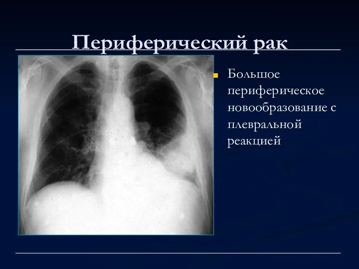 Периферический рак Большое периферическое новообразование с плевральной реакцией