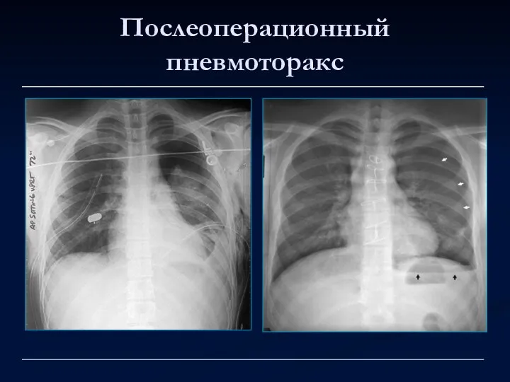 Послеоперационный пневмоторакс