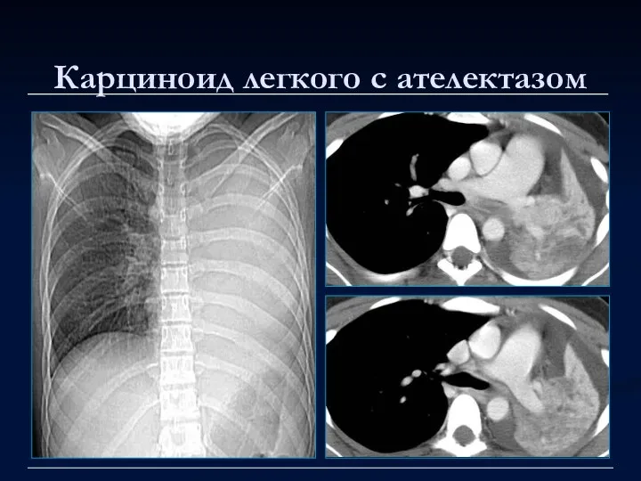 Карциноид легкого с ателектазом