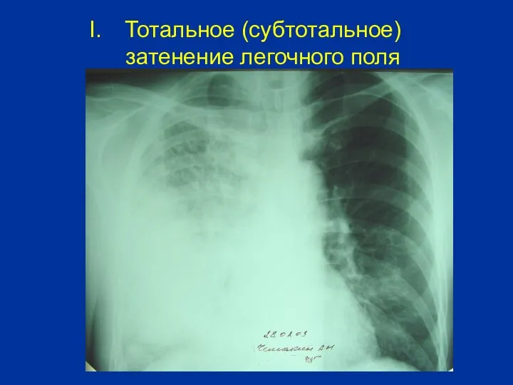 Тотальное (субтотальное) затенение легочного поля