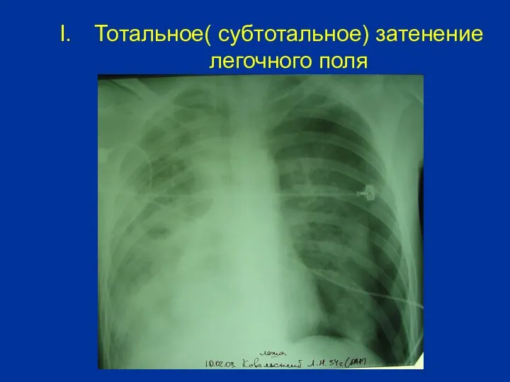 Тотальное( субтотальное) затенение легочного поля