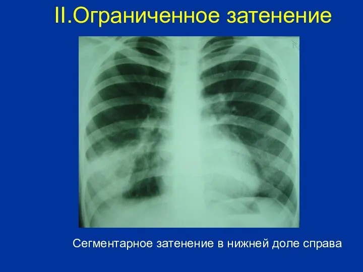 Сегментарное затенение в нижней доле справа II.Ограниченное затенение