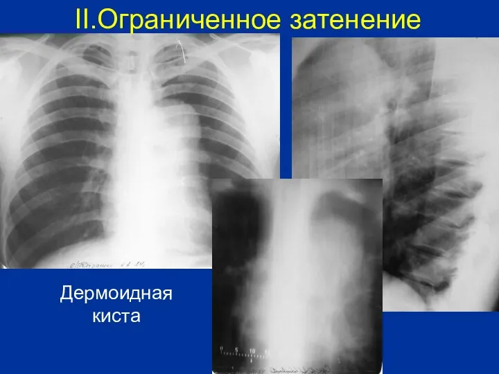 Дермоидная киста II.Ограниченное затенение