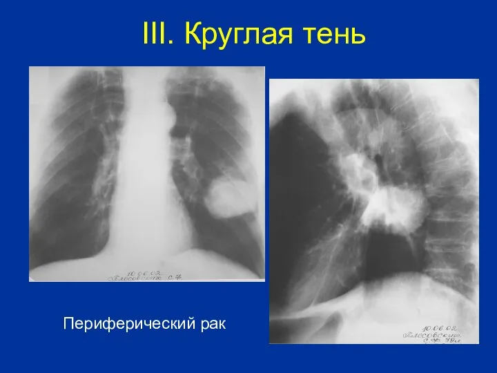 Периферический рак III. Круглая тень