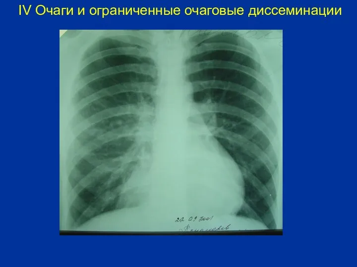 IV Очаги и ограниченные очаговые диссеминации